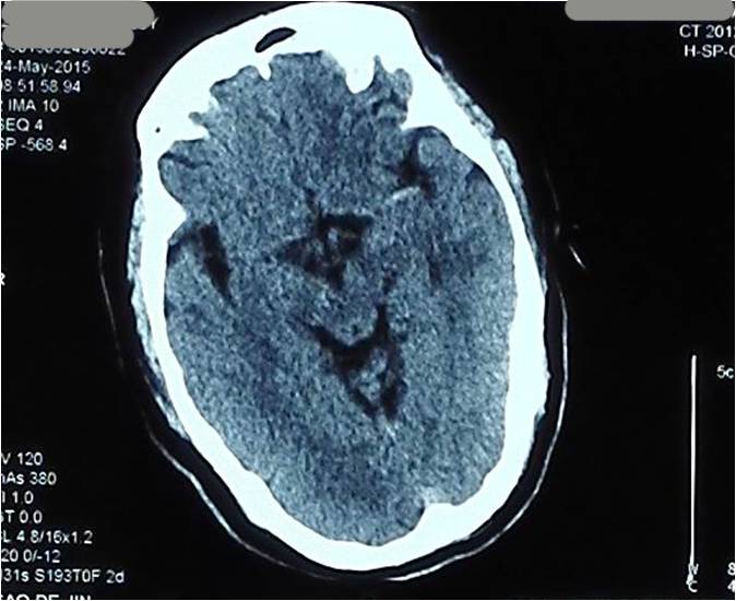 缺血性脑卒中术后管理,急性缺血性脑卒中血管内治疗
