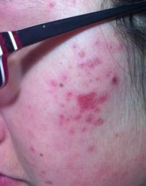 孕妇长痘痘消炎最快方法,孕妇怀孕脸上长痘痘怎么回事