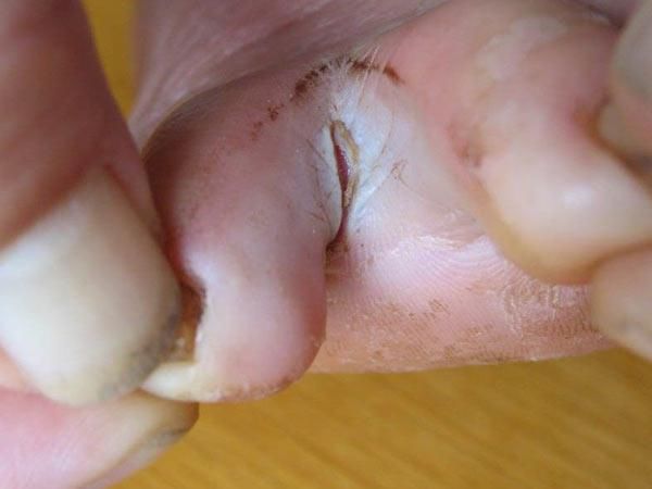 治脚癣手癣最有效的偏方,除去脚癣的中药有什么