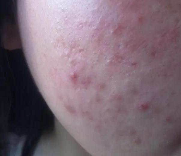 治青春痘最有效的方法,怎样治青春痘比较好