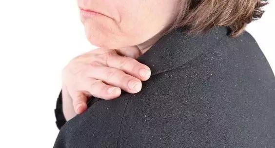 人为什么会有头屑？原因竟然是这样！｜世萱堂