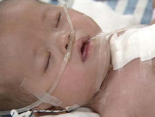 妈妈哭诉：先天愚型宝宝重病，要不要倾家荡产去治