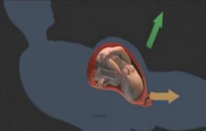 分娩时进行“剖腹产”手术全过程（附图）