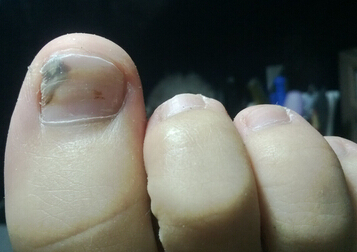 灰指甲治疗颜色正常了但还是很厚,灰指甲是指甲颜色变黑吗