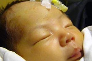 治疗新生儿黄疸最有效的办法,新生儿黄疸怎么造成的