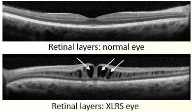 基因治疗auc法,基因疗法眼疾
