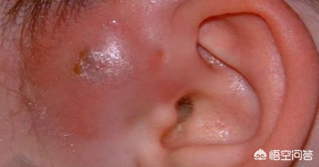 有些人耳朵有一个小洞,有的人耳朵上为什么有小洞洞