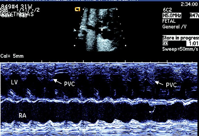 胎儿心律失常超声视频,胎儿快速型心律失常超声指标