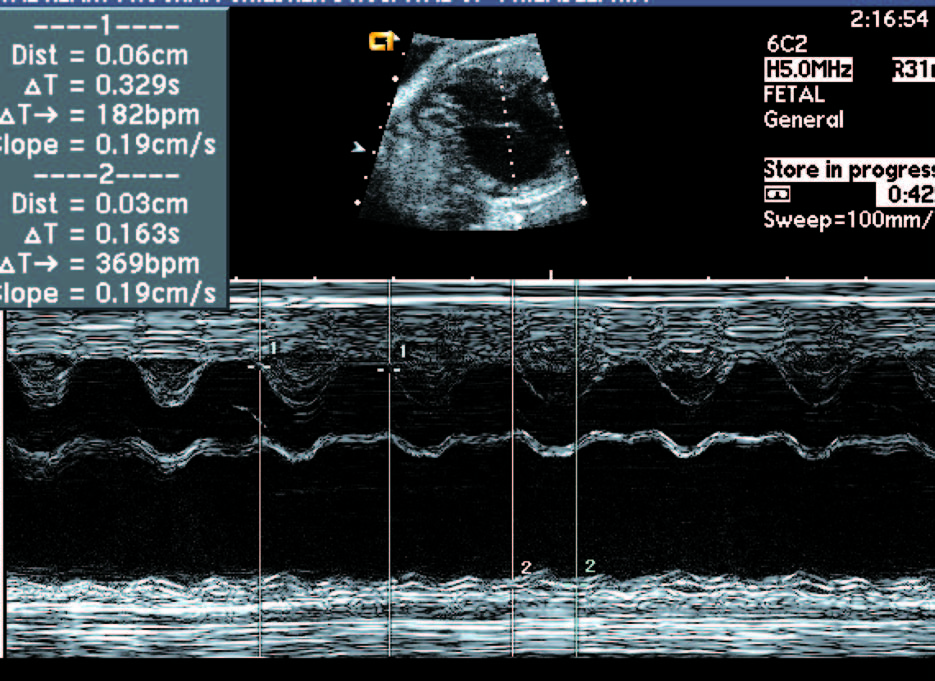 胎儿心律失常超声视频,胎儿快速型心律失常超声指标