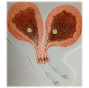 双子宫孕妇隔月生产,双子宫怀孕四胞胎