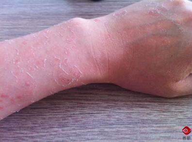 夏日军训旅行防晒,军训脸晒伤了怎么快速恢复