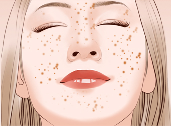 脸上长雀斑有损“面子工程”，民间偏方帮你回归颜值