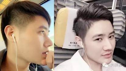 植发亲历,亲身体验植发