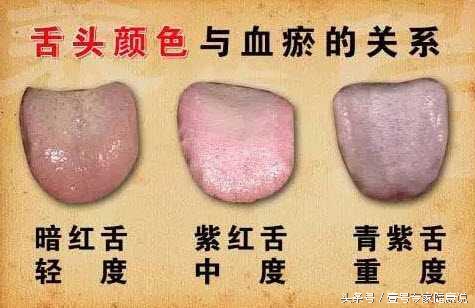 中医说舌头都是牙印是怎么回事,舌头暗紫中医调理案例