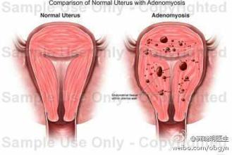 女性在什么情况下要切除子宫,女人在什么情况下要切子宫