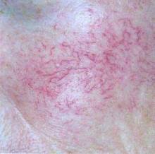 皮肤出现红血丝怎样修复,皮肤薄有红血丝有什么办法缓解