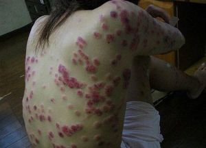 为什么红斑狼疮患者都是漂亮女生,红斑狼疮为啥都是女性