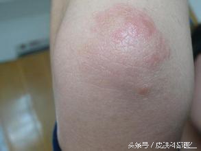 上眼皮神经性皮炎痒怎么办,两个眼皮痒是神经性皮炎吗