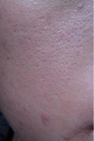 为什么皮肤毛孔粗大,毛孔粗大的真正原因到底是什么