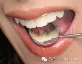 常见排齐牙齿的四大方法,牙齿拥挤重叠矫正过程