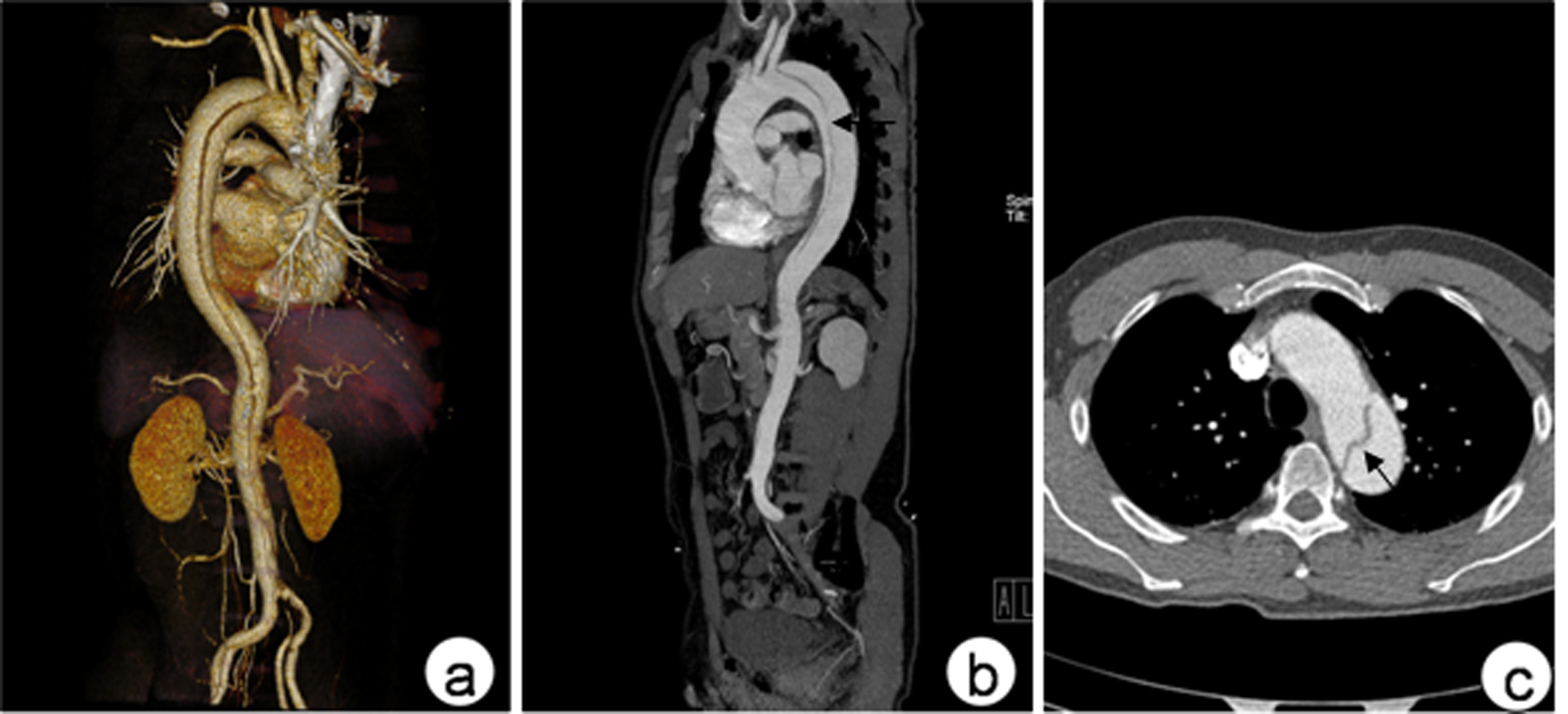美国治疗主动脉夹层,倪海厦治疗主动脉夹层
