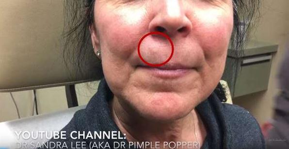 医生从她人中上的不明肿瘤一刀切下去后，这东西竟然蹦出來！慎入