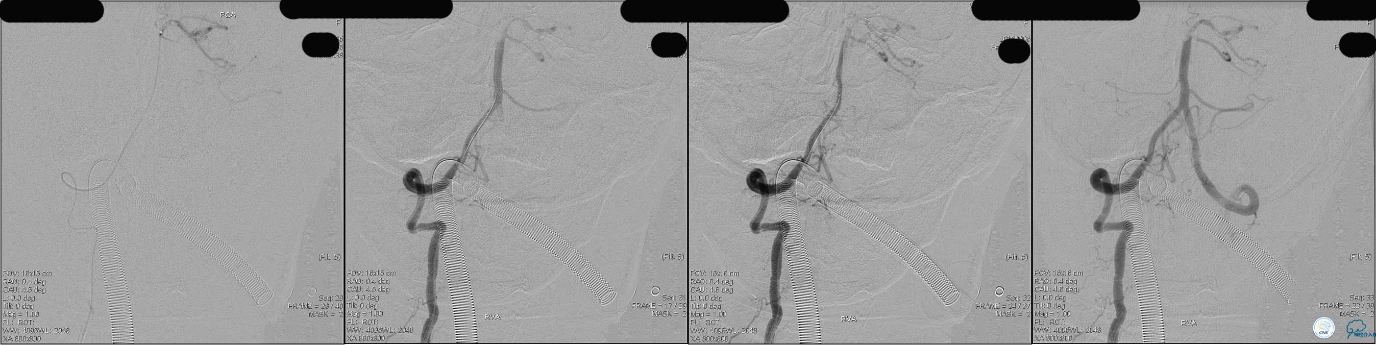 冠状动脉慢性闭塞的介入治疗,颅外段锥动脉狭窄的介入治疗