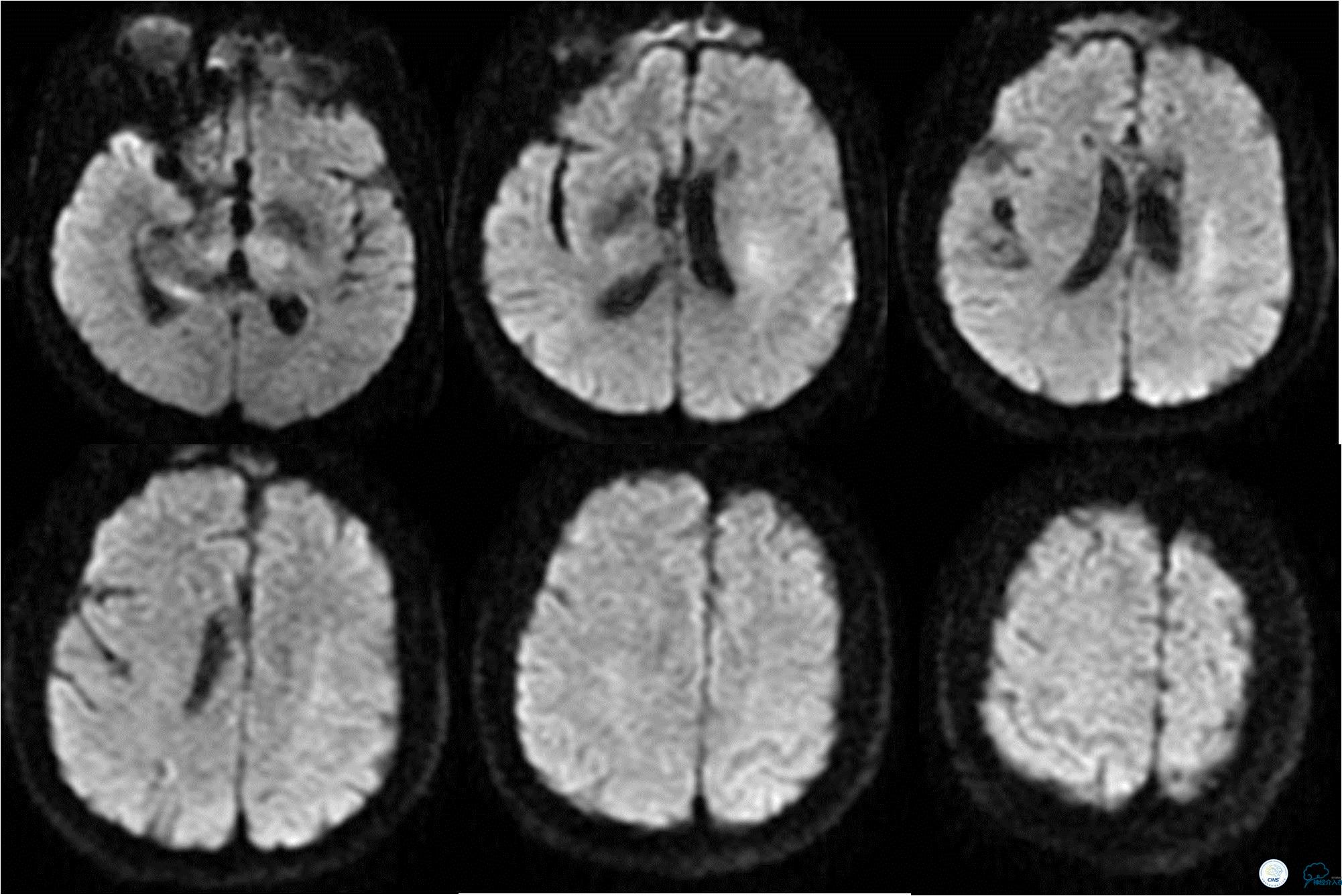 冠状动脉慢性闭塞的介入治疗,颅外段锥动脉狭窄的介入治疗
