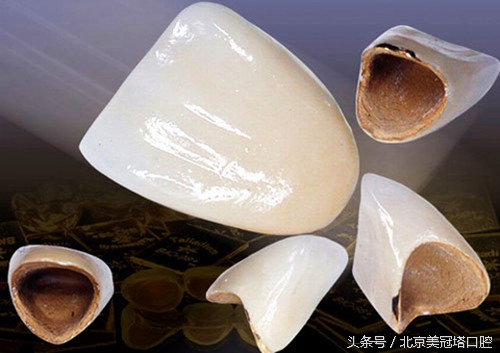 镶的烤瓷牙有什么不习惯的吗,为什么一定要镶烤瓷牙