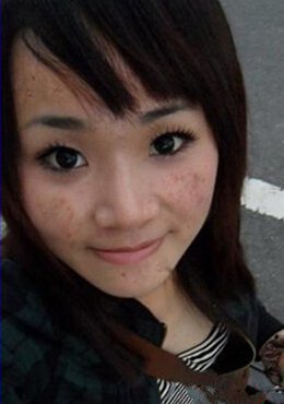 祛痘淡化痘印男女皆可,祛痘不留疤痕最有效方法