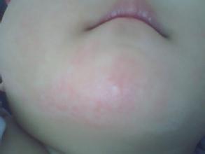 婴儿湿疹一直复发是什么病因,湿疹的病因及发病机制是什么