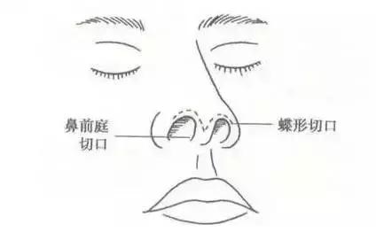 为什么鼻子隆完颜值一下就上来了,为什么隆完鼻露鼻孔还是很明显