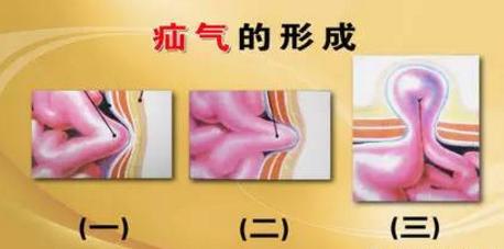3岁女孩腹股沟有个包块不疼,4岁女孩腹股沟疝有点鼓包