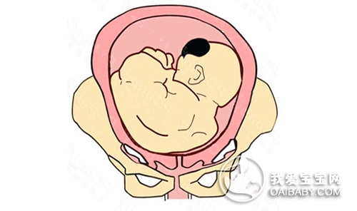 胎位不正怎么办?造成胎位不正的原因是什么?