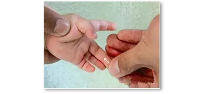 孩子起口疮小儿推拿,小儿推拿嘴角口疮