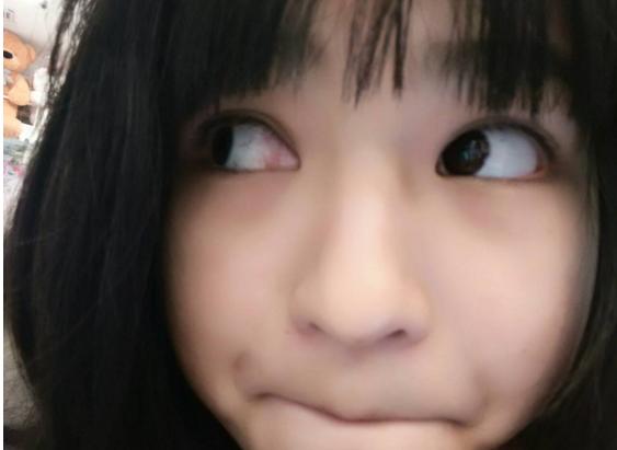 有那种除眼睛血丝的眼药水吗,眼睛有血丝发黄浑浊用什么眼药水