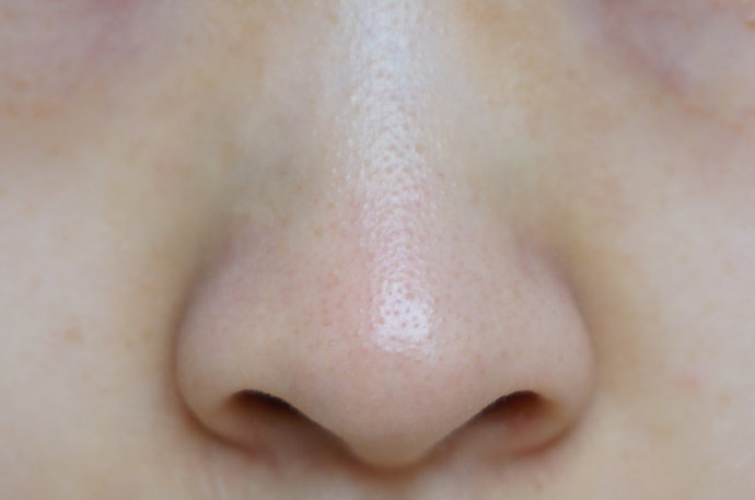 鼻子黑头毛孔粗大小方法解决,鼻子黑头毛孔粗大的改善方法