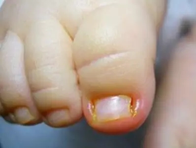 宝宝甲沟炎严重导致指甲剥离,宝宝甲沟炎需要剪指甲吗