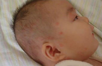 婴儿湿疹一定要保湿吗,婴儿湿疹严重要用激素吗