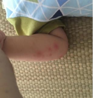 婴儿皮肤湿疹如何治疗,儿童湿疹溃烂怎么办