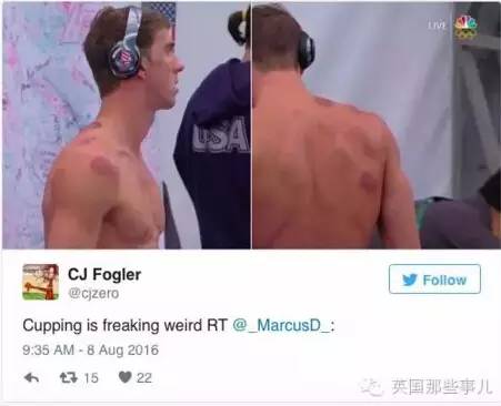 拔罐靠谱吗,拔罐真的有用吗测评