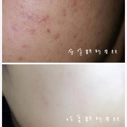 长过痤疮的脸如何修复,脸上长疮的最快消除方法偏方