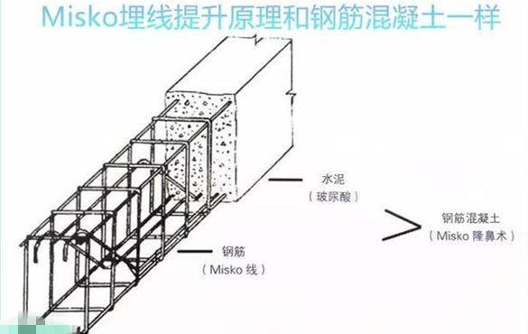 埋线隆鼻和假体隆鼻,鼻梁塌又不想做手术怎么办