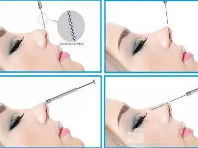 埋线隆鼻和假体隆鼻,鼻梁塌又不想做手术怎么办