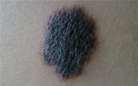 孙红雷黑色素瘤片段,孙红雷黑痣长在什么位置