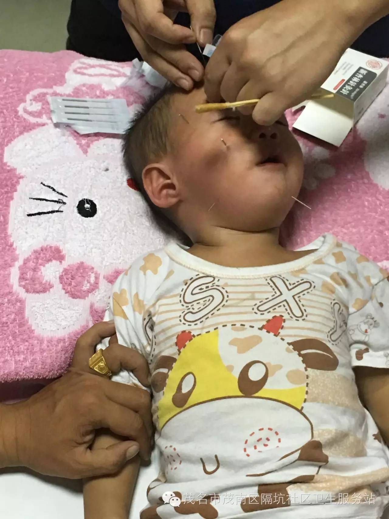 宝宝面瘫有治愈的可能吗,宝宝面瘫