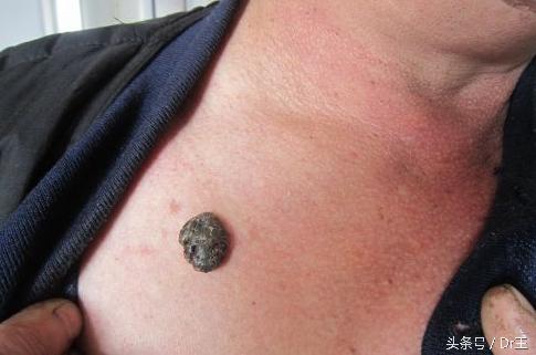 牙龈变色暗示哪里有病,牙龈变黑是什么征兆