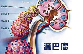 弥漫大b细胞淋巴瘤治疗,霍奇金淋巴瘤治疗总费用