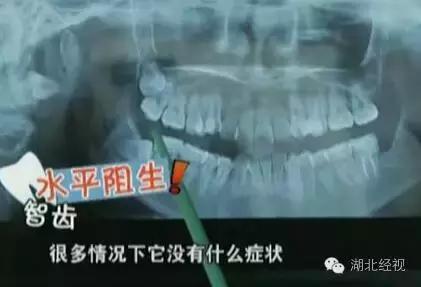 下面的智齿拔了上面的可以不拔吗,下智齿只拔了一侧另一侧不拔行吗