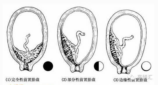 胎盘的十大知识,不同阶段的胎盘